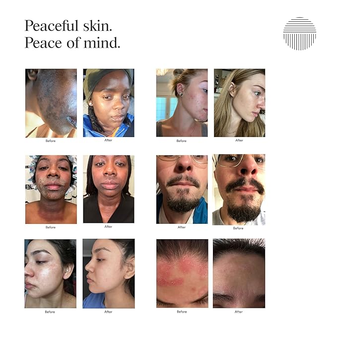 Calming Seborrheic Serum, Dermatologist Recommended, Topical Serum For Hair, Face, and Body (4oz)