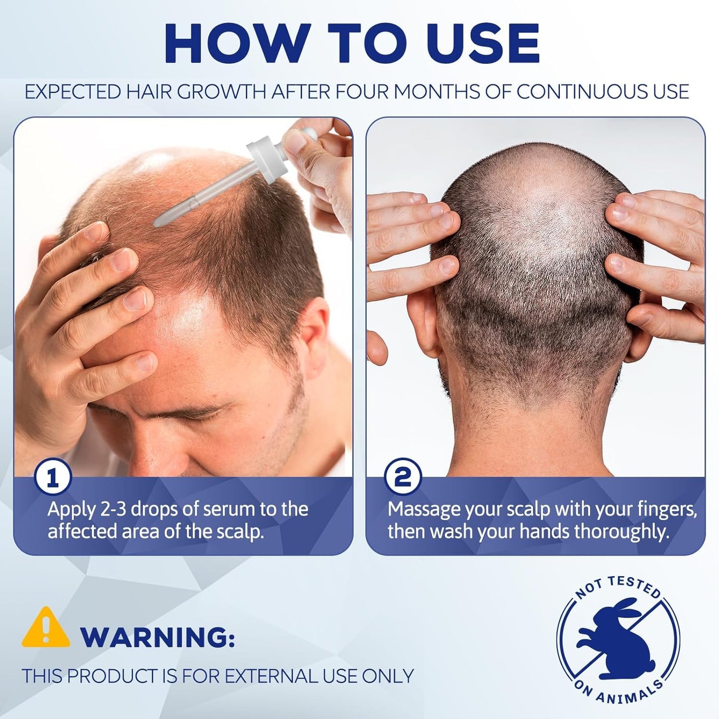 5% Minoxidil for Men and Women, Hair Regrowth Treatment for Thinning Hair and Hair Loss, Topical Solution - 1 Months Supply - Dermatologist recommended (Pack of 1)