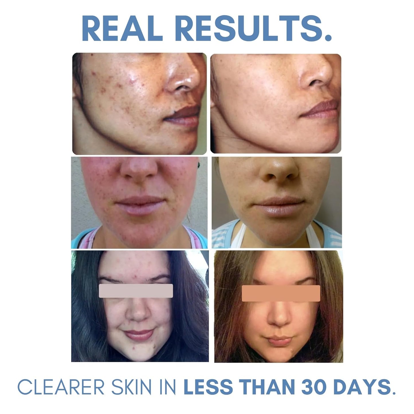 Acne Lotion with Benzoyl Peroxide, Acne Cream, Face Moisturizer Acne Prone Skin, Acne Moisturizer for Face, 1.8 Fl oz