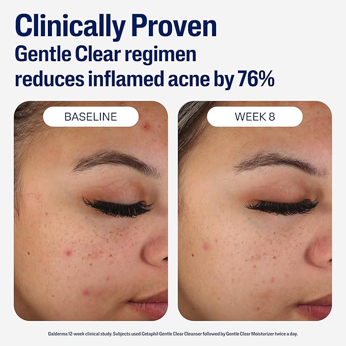 Cetaphil Face Moisturizer, Gentle Clear Mattifying Acne Moisturizer With 0.5% Salicylic Acid, Hydrates and Treats Sensitive Acne Prone Skin, Skin Care for Sensitive Skin, 3oz