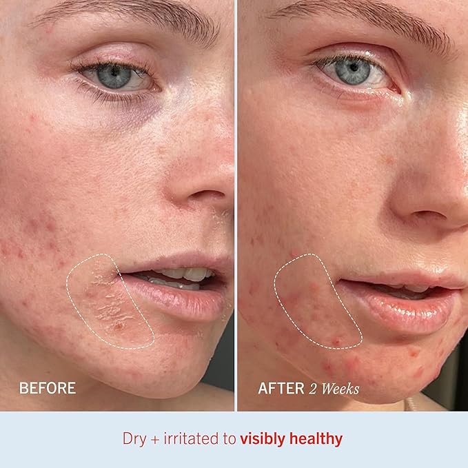 First Aid Beauty - Ultra Repair Cream - Hydrating Face & Body Moisturizer - Whipped Colloidal Oatmeal Clinically Proven to Strengthen Skin Barrier in 7 Days - Helps Relieve Eczema, 6oz Plus 1oz Tube